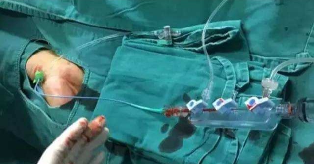 做了心脏造影后手腕刀口有渗血,做了心脏造影后伤口多少天能见水