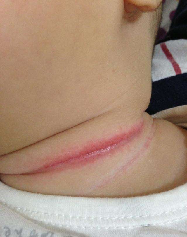 宝宝淹脖子是什么原因引起的,宝宝容易淹脖子怎么办