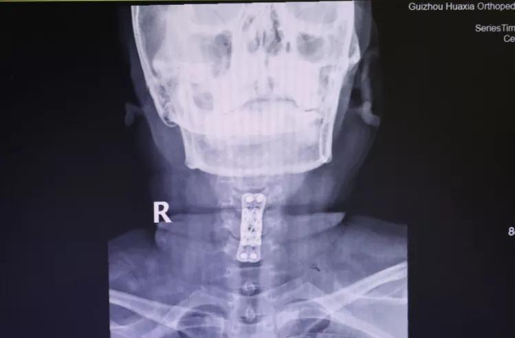 颈椎病手麻手痛怎么治疗,颈椎病手麻无力怎么锻炼