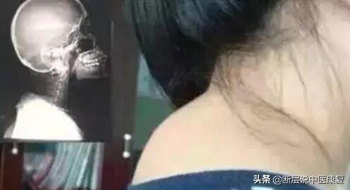 脖子后面的富贵包按摩能消除吗,脖子后面富贵包怎么彻底消除