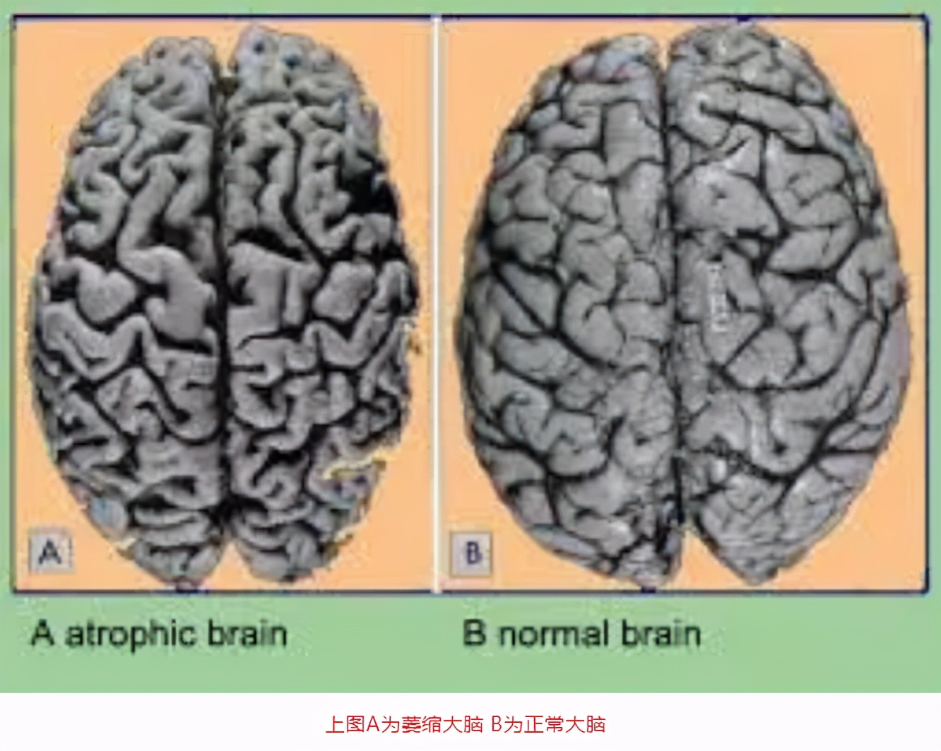 57岁查出脑萎缩正常吗,58岁查出脑萎缩还能活多久