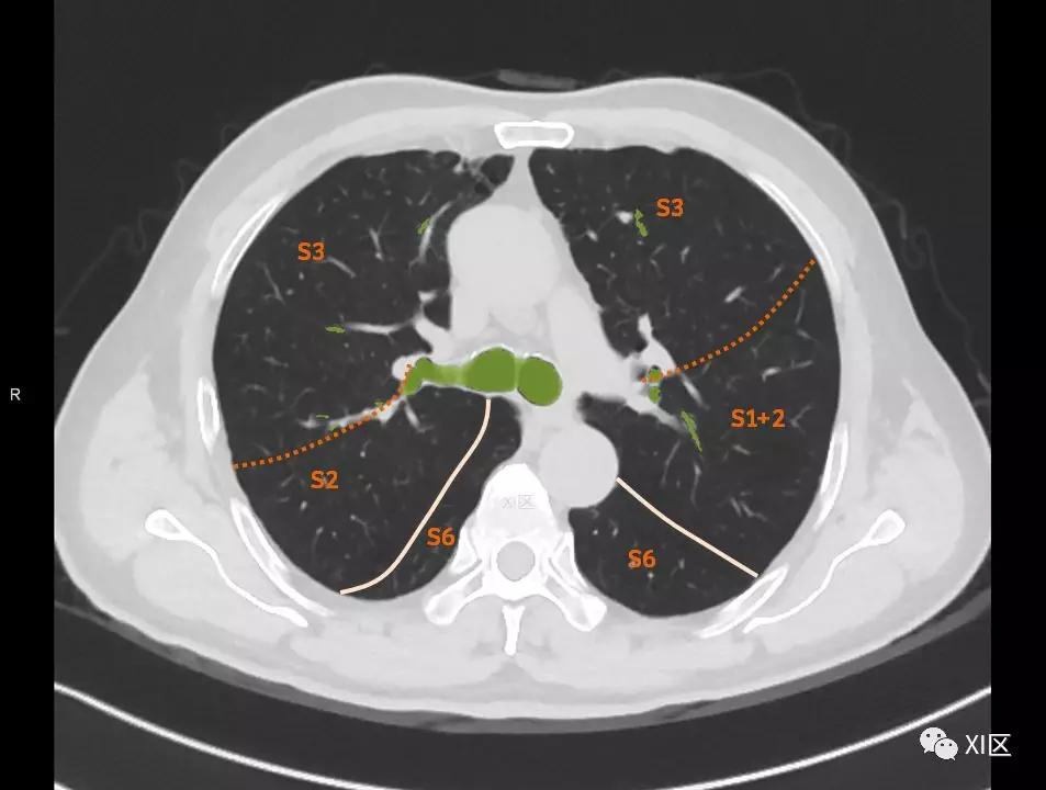 如此详细的肺部影像解剖，有点儿酷