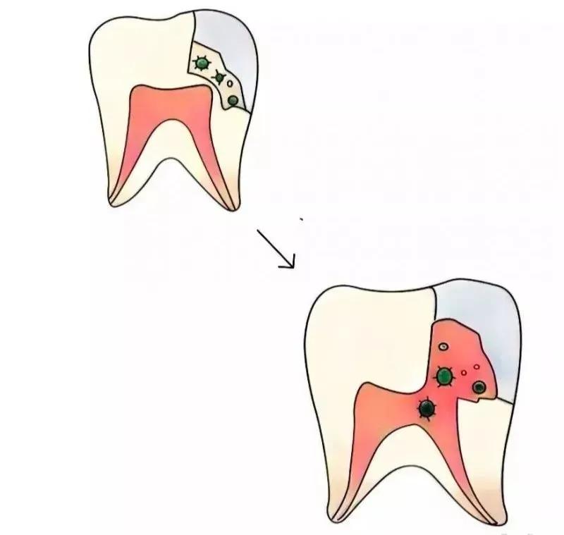 补一颗牙把好牙打磨了,上牙把下牙磨了一个坑