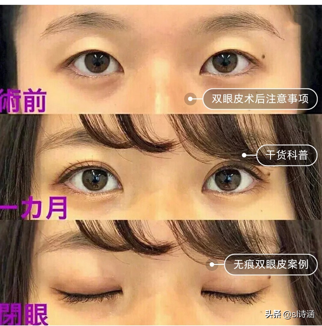 做完双眼皮之后有什么注意事项,做完双眼皮过后应该注意些什么