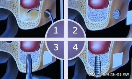 缺牙太久邻牙倾斜可以磨掉吗,缺牙太久导致旁边的牙倾斜了