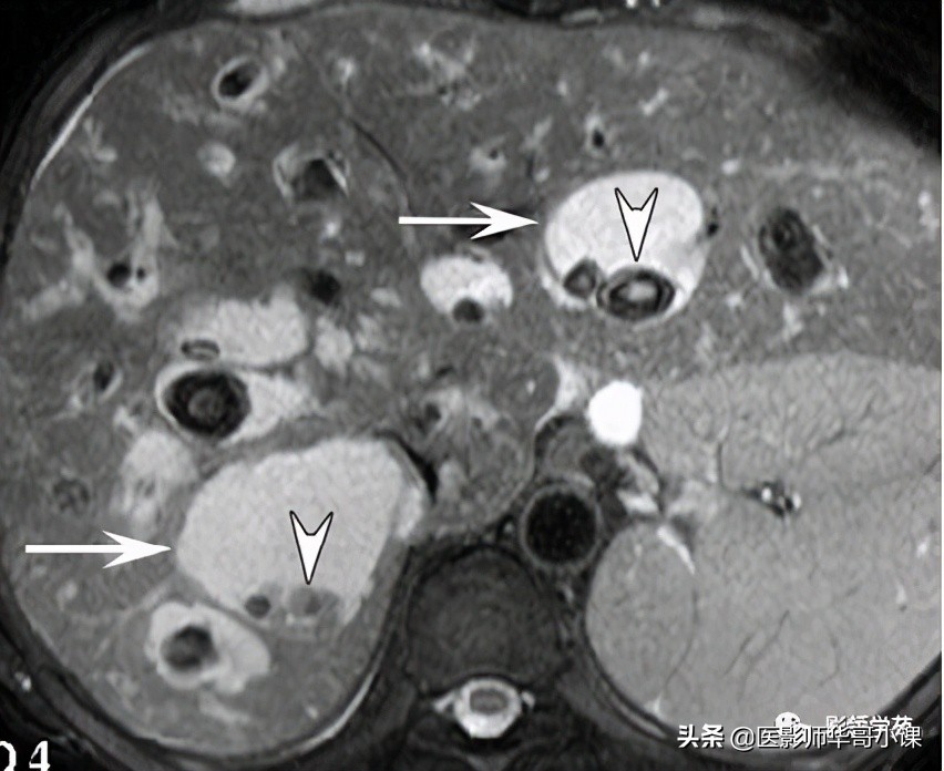 胆总管变异,胆胰管解剖