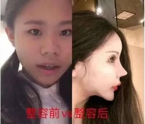 做6次双眼皮4次鼻子，下巴似铁锥眼睛整成球，16岁就整成这样好吗