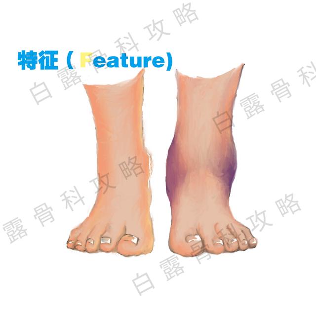 崴脚后48小时紧急处理,崴到脚紧急处理