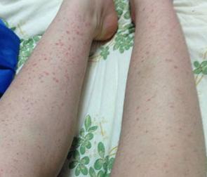 过敏性紫癜用药多久后症状能缓解,儿童过敏性紫癜的症状什么引起的