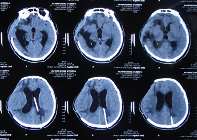 脑外伤开颅手术后脑积水,脑外伤手术后脑脊液鼻漏怎么治疗