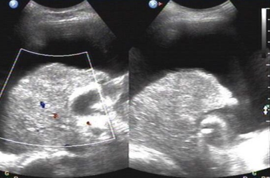 脂肪肝的防治与调养,脂肪肝的防治食物