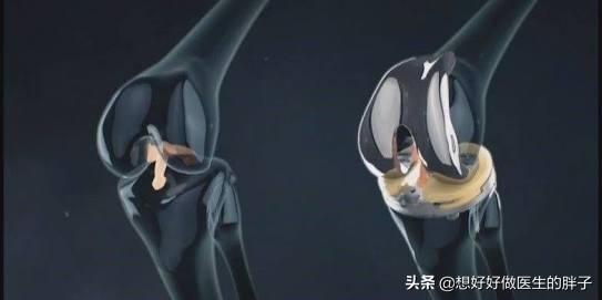 膝盖怎样知道有骨刺,膝盖有骨刺中医怎么治