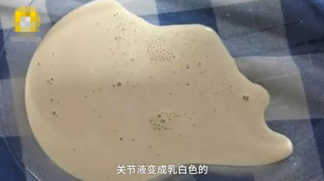 29岁男子关节抽出牛奶色液体，天天喝啤酒一天最多喝10瓶