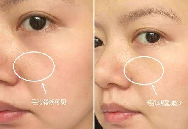 皮肤敏感泛红长痘怎么办,皮肤粗糙泛红起痘