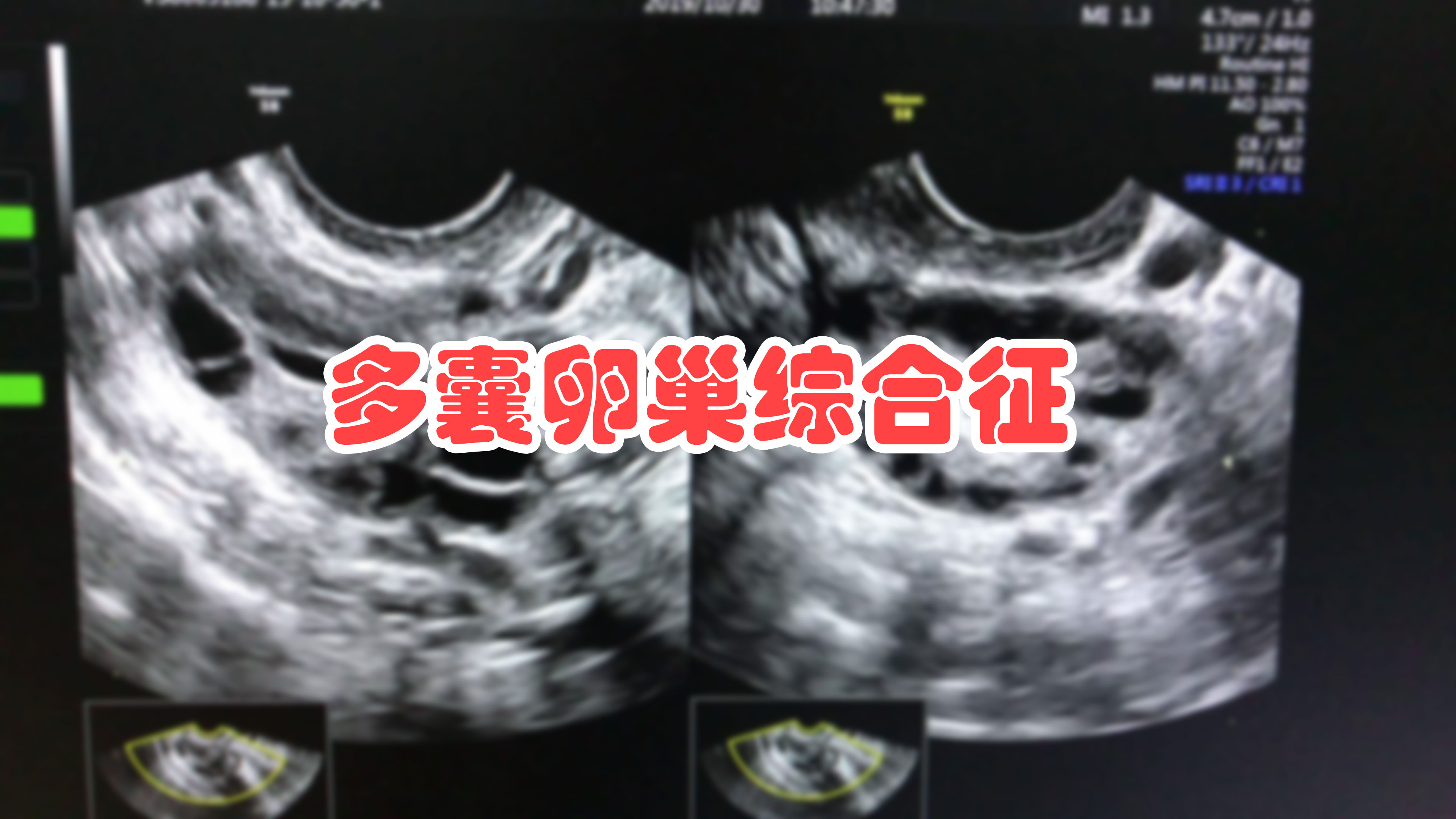 多囊，为什么有卵子不能排出？