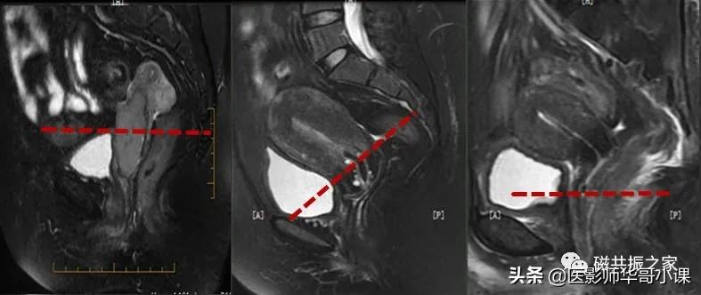 「精品课件」带大家看看，磁共振子宫MRI要如何扫描？
