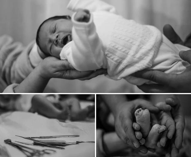 男宝包皮过长什么时候治疗,初到人间的宝宝