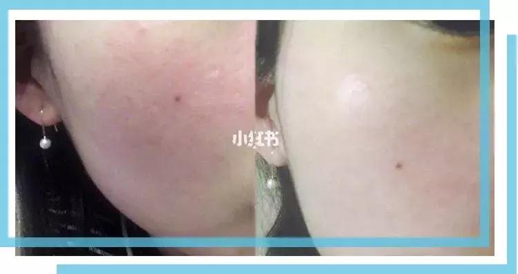 如何有效的祛痘印医美面膜,消炎祛痘的医美面膜