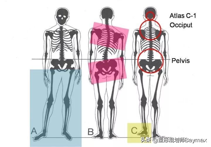 骨盆前倾脊柱侧弯高低肩如何调整,男士高低肩骨盆前倾体态矫正训练
