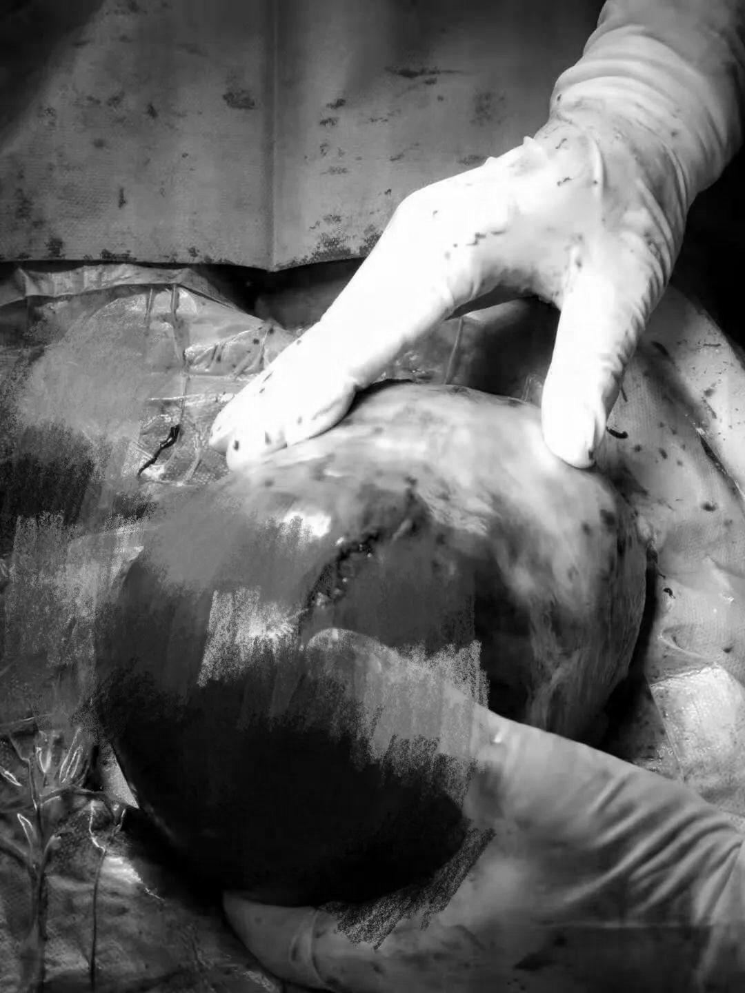 罕见病例!剖宫产中孕妇子宫肌瘤竟有胎头般大小