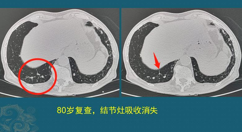 3个肺结节,3年肺结节增长了0.3毫米严重吗