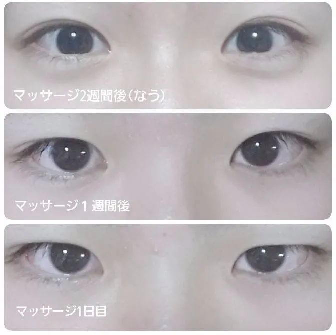 日本双眼皮整形视频,日本整容大师演示