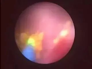 钬激光肾结石无创手术,钬激光碎石后结石还没出来怎么办