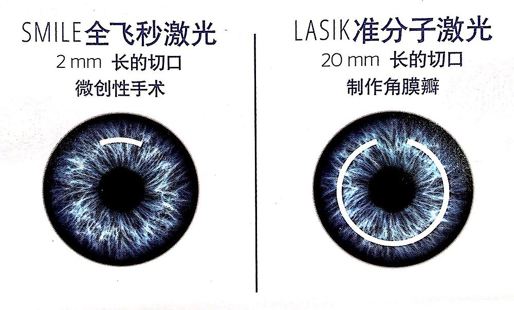 隐形眼镜有散光加近视,近视度数高有散光戴隐形眼镜