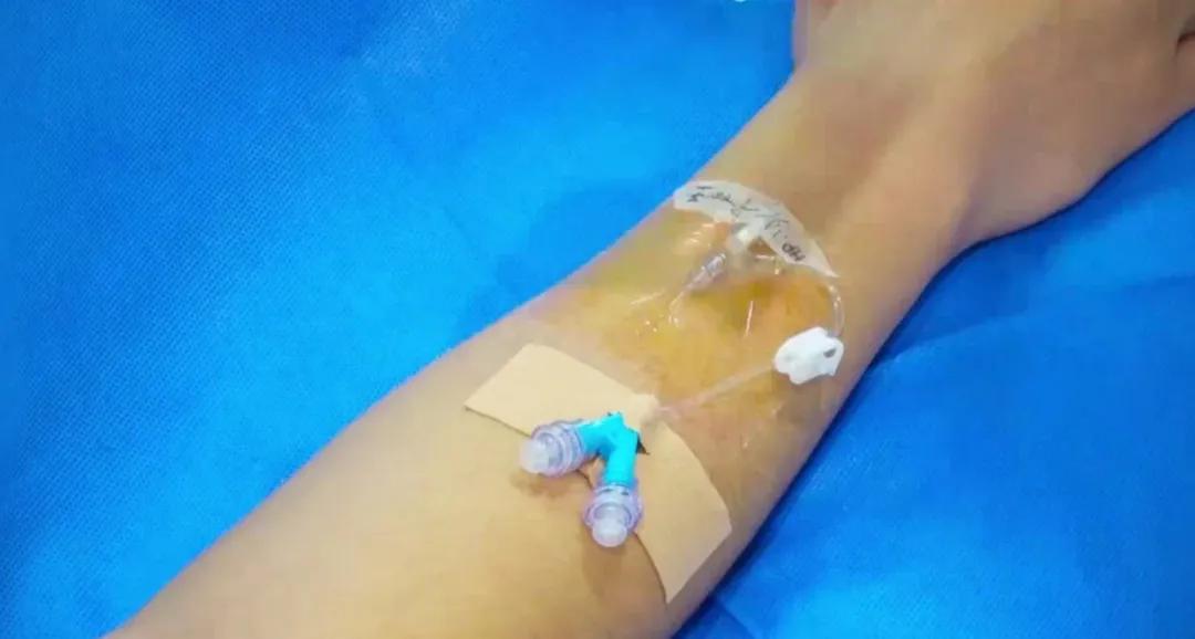 留置针软管断裂有什么症状,留置针的软管断在里面怎么办