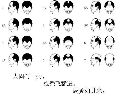 我国2.5亿人“秃了”，科学家找到“元凶”后反而更苦恼，咋回事