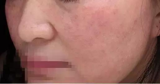 洗脸洗多了毛孔变大怎么办,洗脸洗成痘痘肌