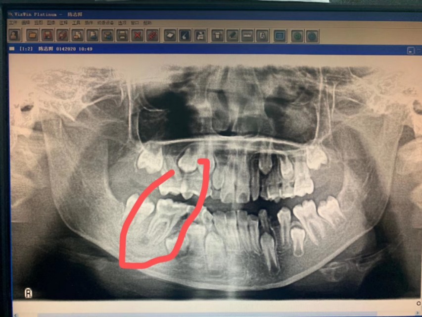 牙源性上颌窦炎牙龈瘘管,牙源性脓肿的症状