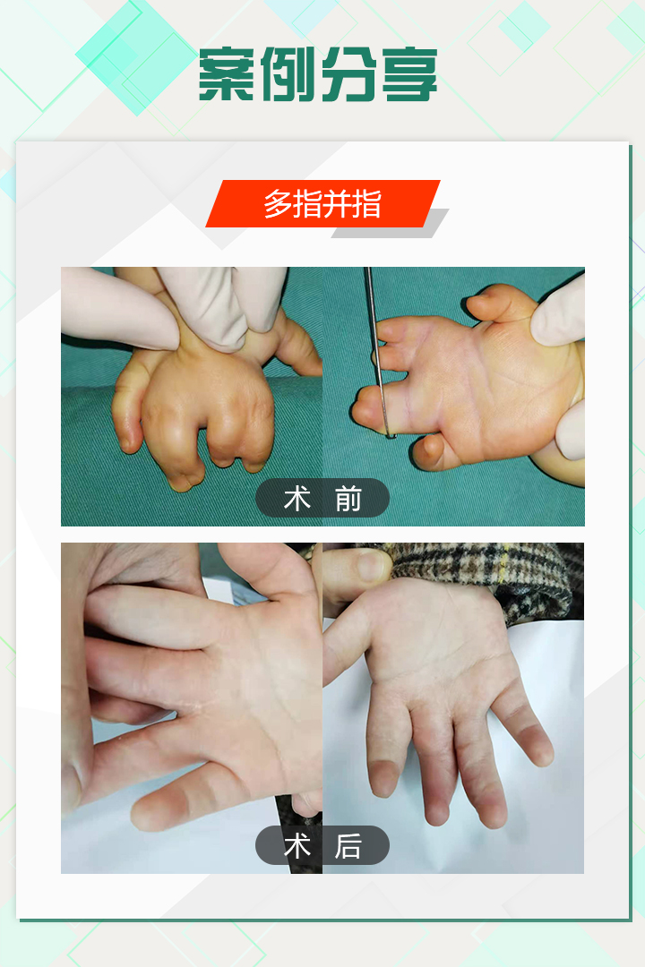 手足外科陈江海微博,手外科专家陈江海