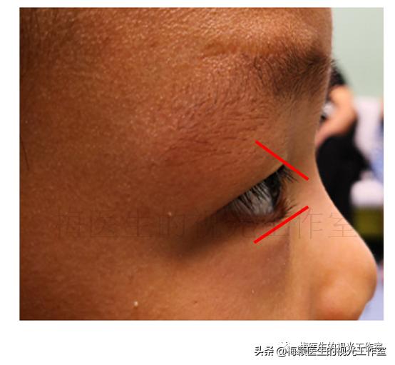 孩子不肯接受眼压计检查,小朋友有必要测眼压吗有必要查吗