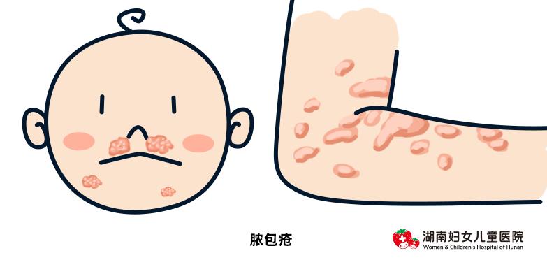 小孩夏天怎么防止痒疹,夏天的宝宝怎么避免热疹