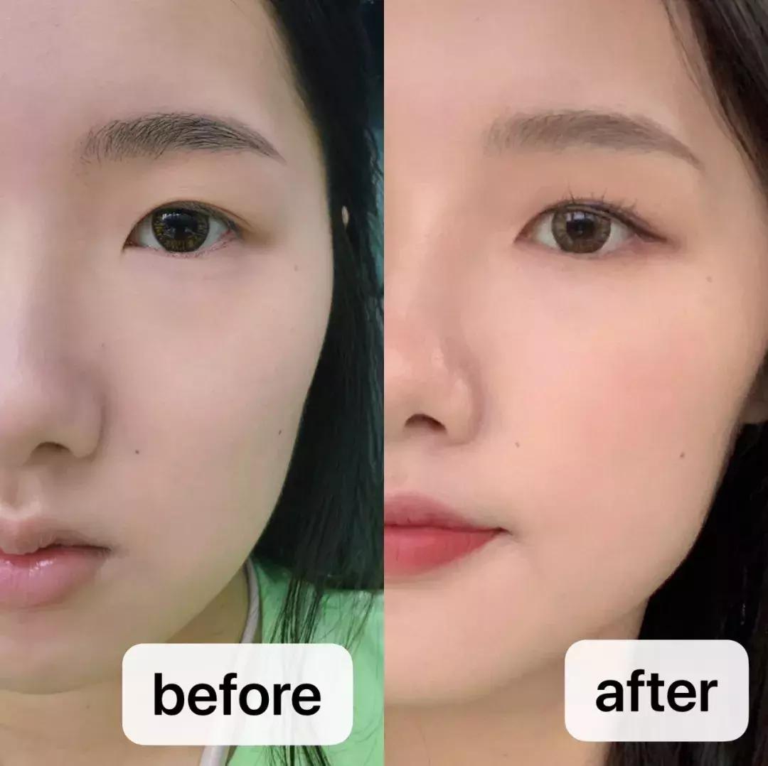 去割双眼皮,去韩国割双眼皮科学不