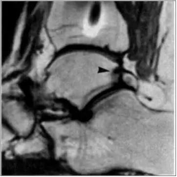 踝关节撞击症问诊,踝关节内侧撞击综合症位置图