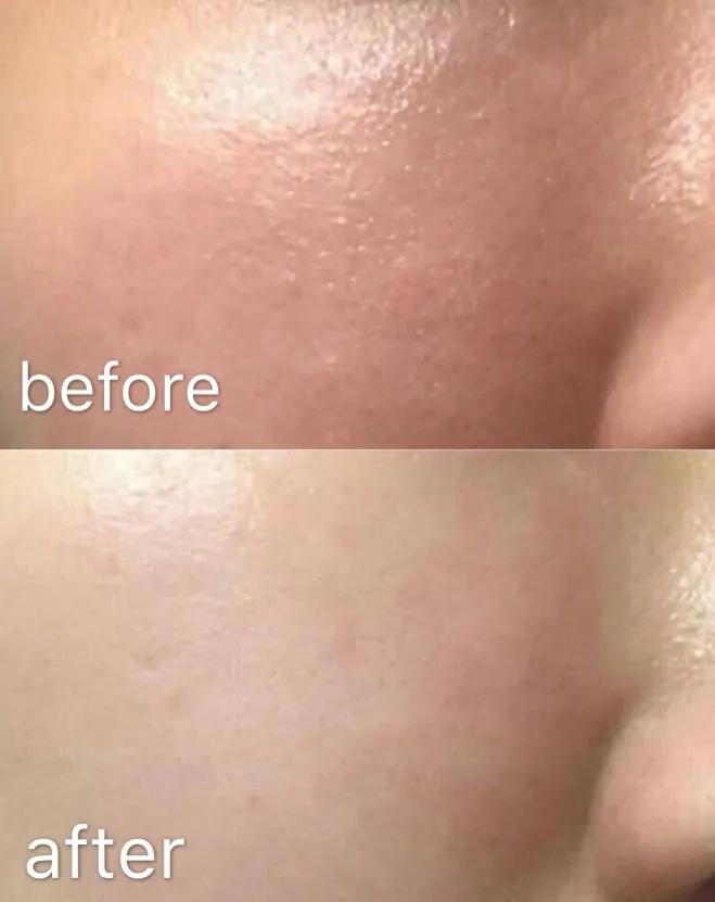 十年战痘肌自救指南,十年痘肌怎么抗痘