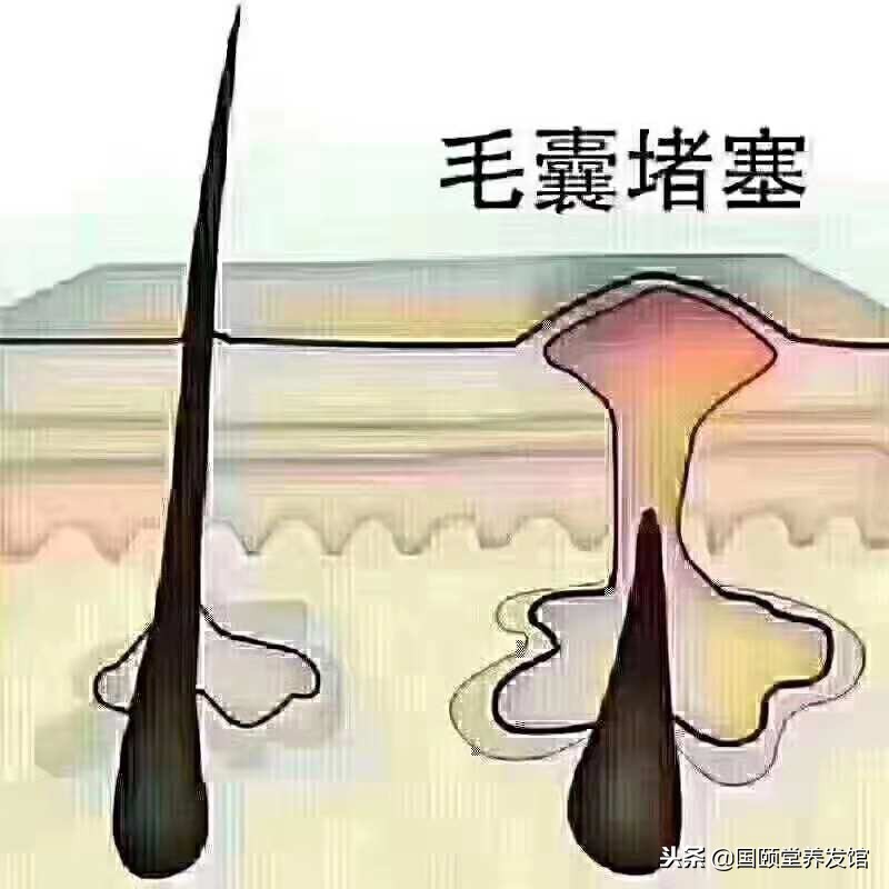 国颐堂养发馆对脱发有效果吗,国颐堂养发馆治白发可靠吗