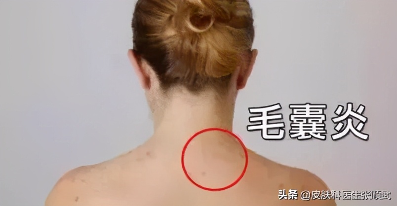 前胸后背长毛囊炎可以自愈吗,背部长毛囊炎怎么消除