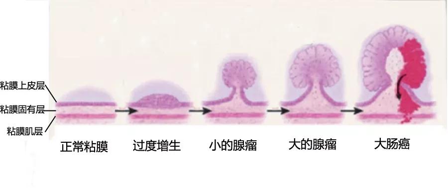 上皮内瘤变是肿瘤吗,什么是上皮鳞状病变
