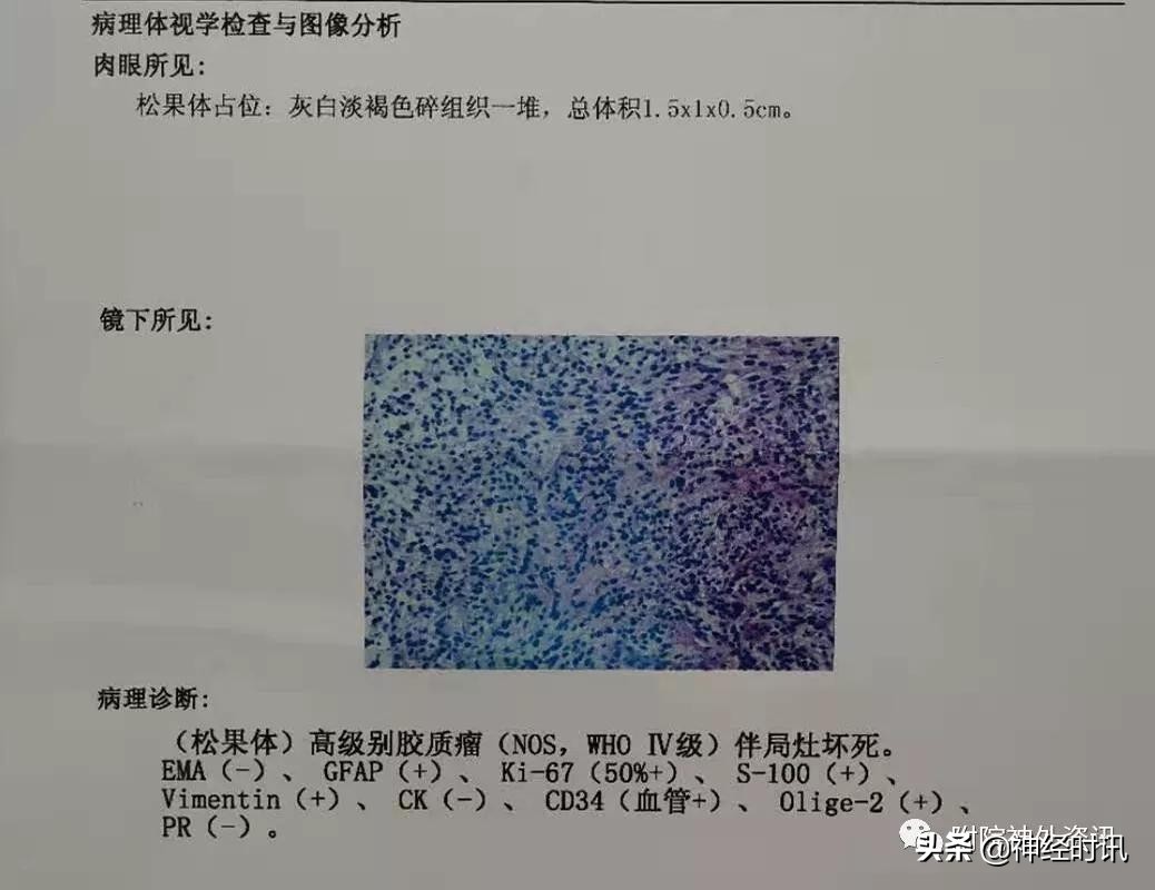 松果体占位怎样治疗,松果体区占位看什么科室