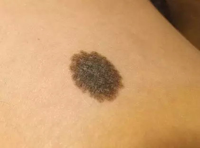 色素痣会变成白癜风吗,右眼脉络膜色素痣是黑色素瘤吗