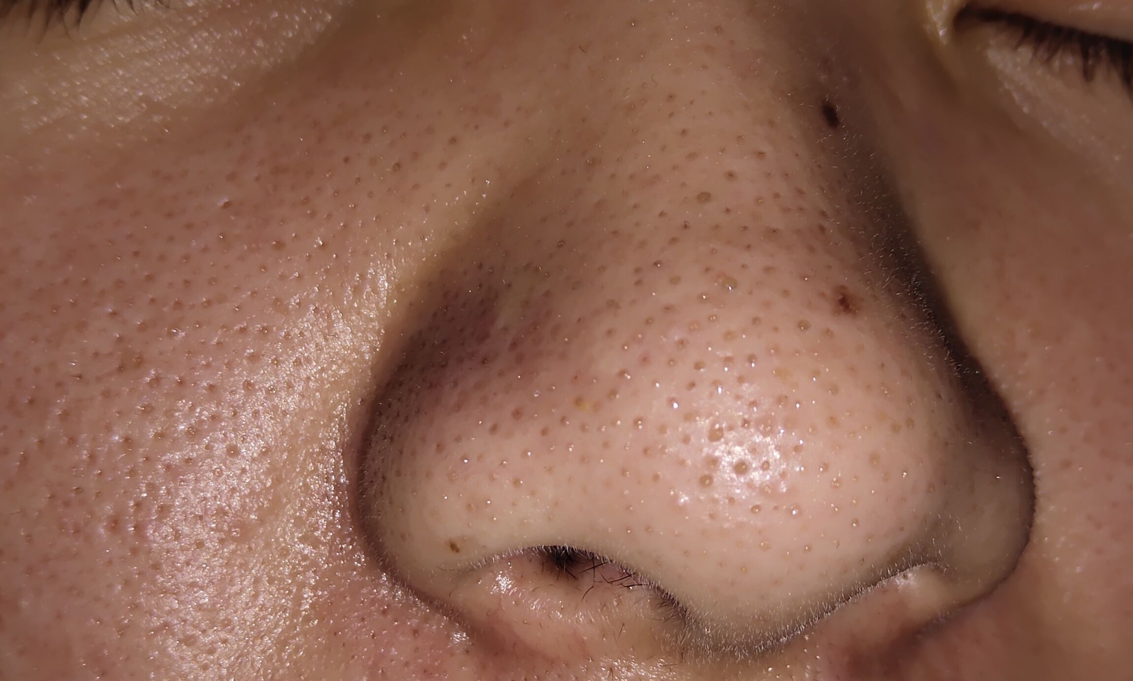 黑头如果不管的话会怎样,如果不清理黑头会怎样