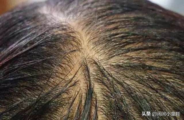 男士头发出油有头屑用什么洗发水,头发干枯毛躁痒有头屑掉发怎么办