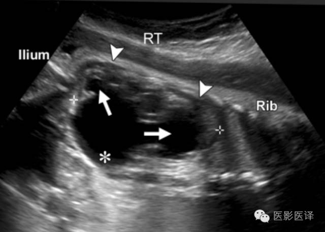 胎儿卵巢囊肿5.6厘米会消失吗,卵巢巨大囊肿与妊娠鉴别
