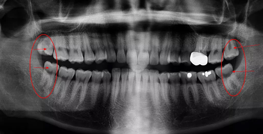 智齿到底要不要拔医生告诉你答案,智齿必须拔掉的五种情况