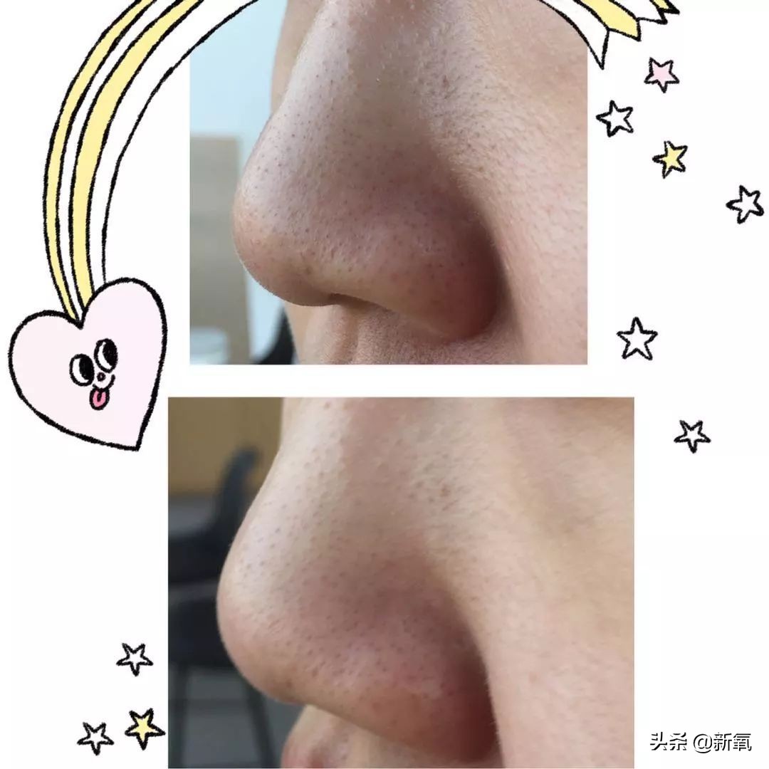 去黑头最有效的方法一个月见效,别挤了教你去黑头的正确方法