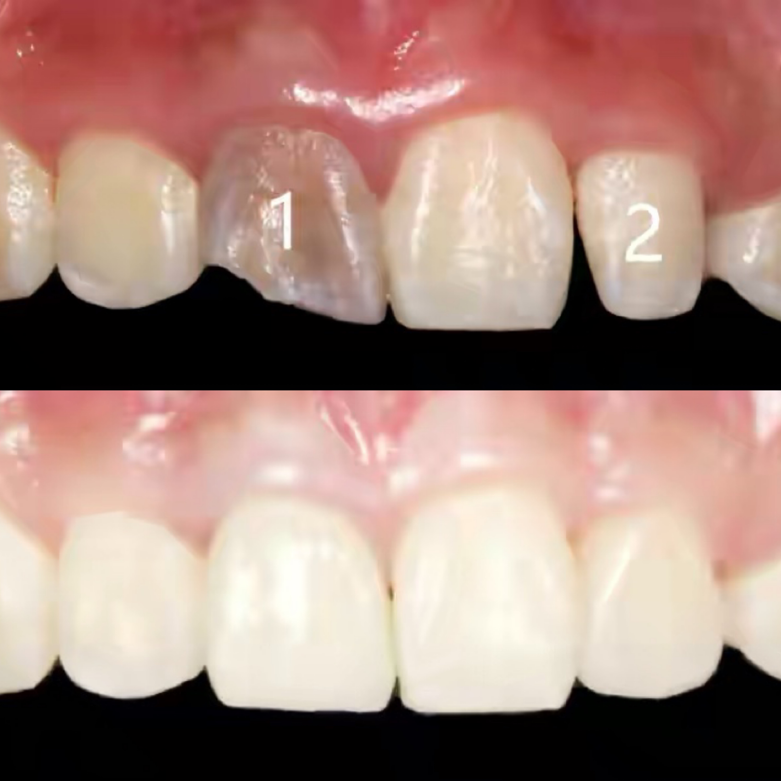 牙齿美白最好的技术,口腔牙齿美白