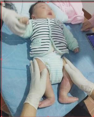 严重马蹄足内翻胎儿能要吗,孕期发现严重的足内翻需要引产吗